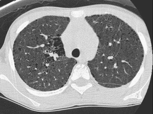 Хроническая обструктивная болезнь легких: когда нечем дышать (авторская ...