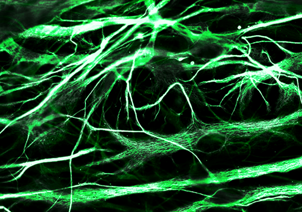 Трансплантация стволовых клеток для лечения болезни Паркинсона