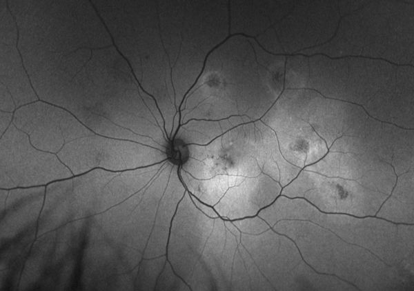 Центральная серозная хориоретинопатия
