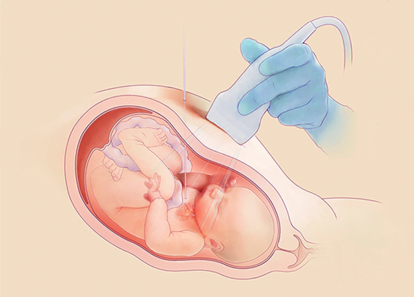 Фетальная хирургия врожденных пороков сердца