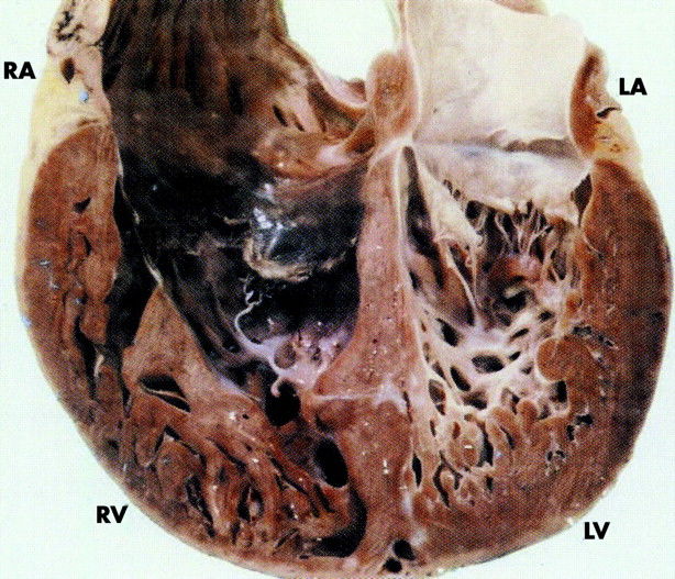 Синдром некомпактного миокарда левого желудочка