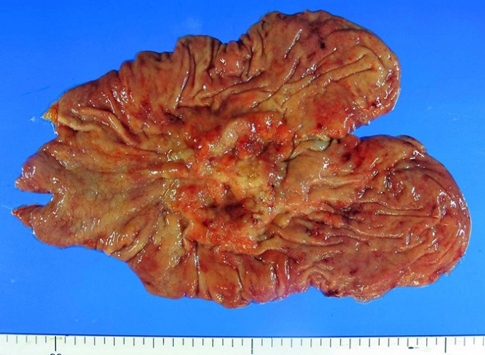Рак желудка патогенез рака желудка