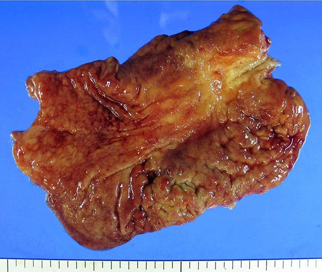 Механизм развития рака желудка
