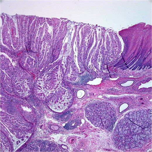 Рак желудка патогенез рака желудка