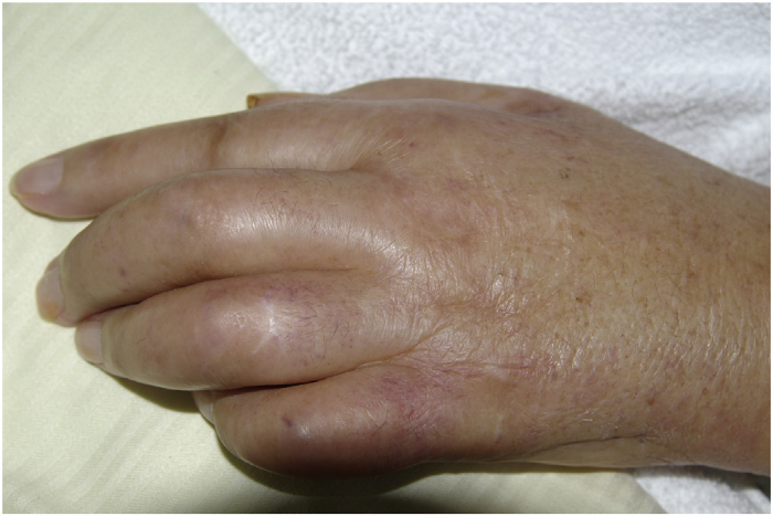 Ревматоидный артрит и паранеопластический синдром thumbnail