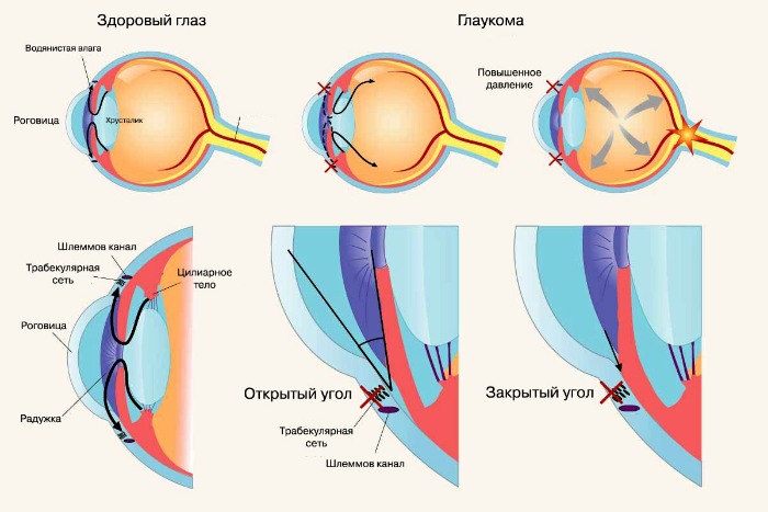 Почему адреналин применяют только при открытоугольной глаукоме
