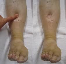 Отеки ног дифференциальный диагноз