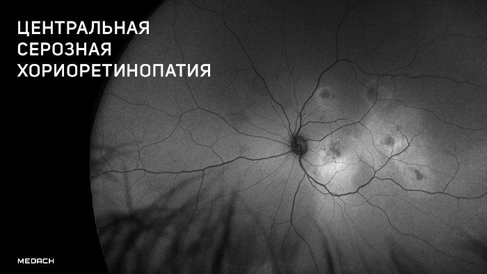 Центральная серозная ретинопатия thumbnail