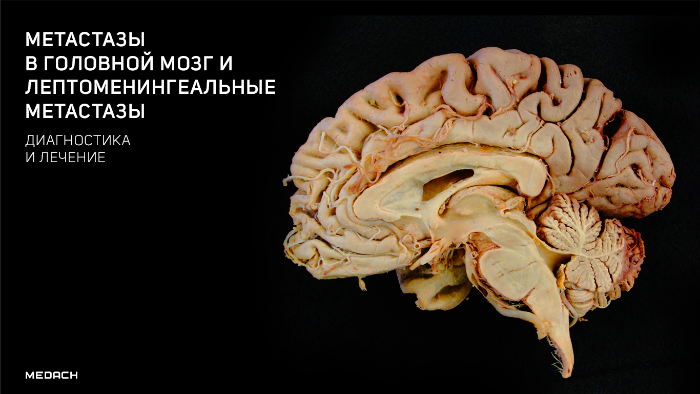 Лечение метастазов мозга. Метастазы в головном мозге. Лептоменингиальное метастазирование головного мозга. Лептоменингеальные опухоли в головной мозг.
