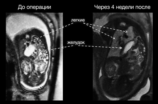 Диафрагмальная грыжа у эмбриона