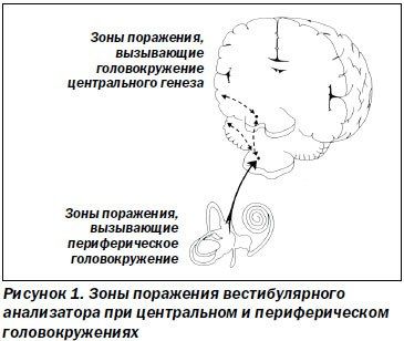Дифференциальна диагностика головокружении неврология