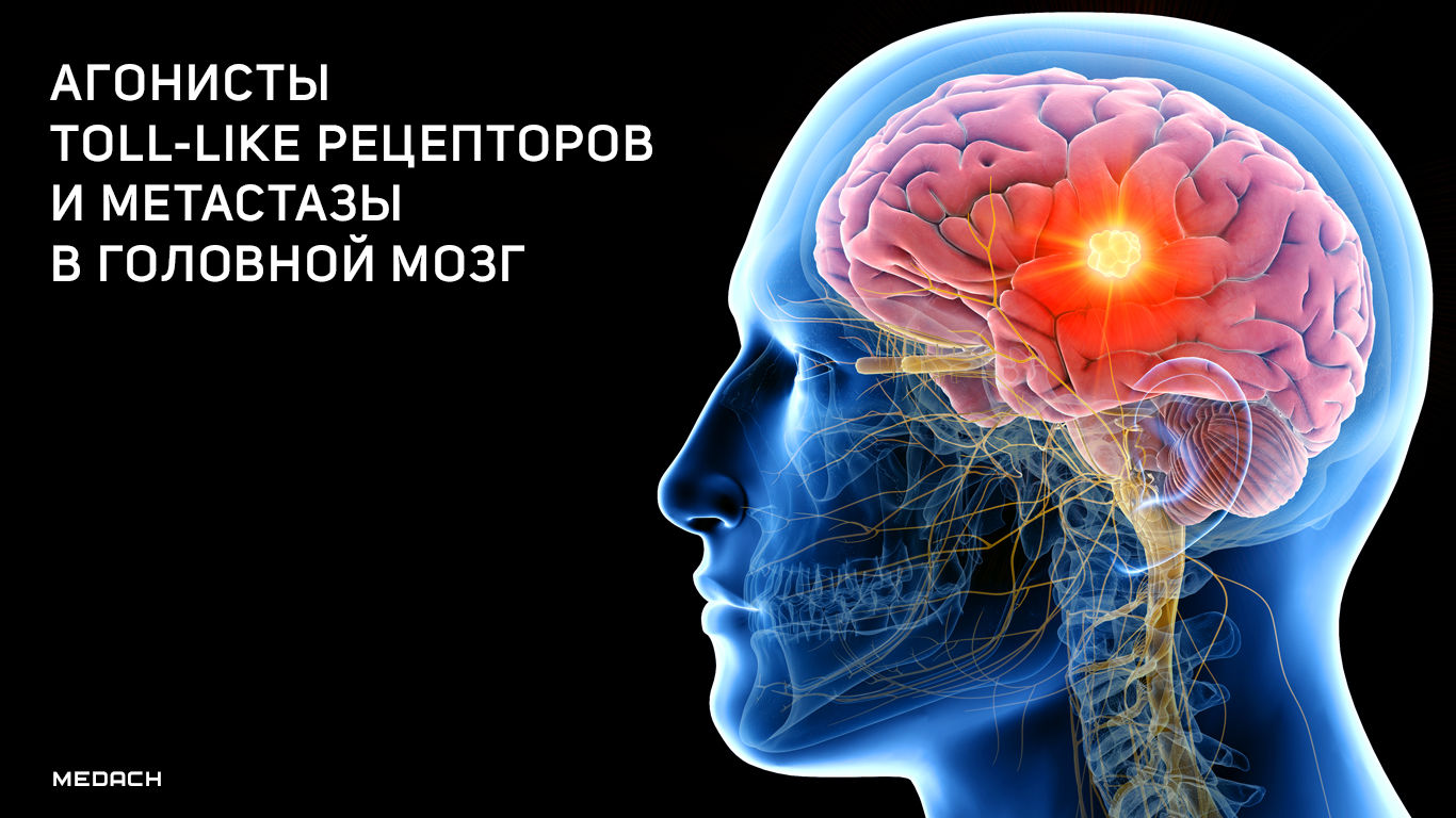 Купить мозг терапи. Мозг и рецепторы. Метастазы в головном мозге. Рецепторы головного мозга. Инсульт при метастазах в головном мозге.