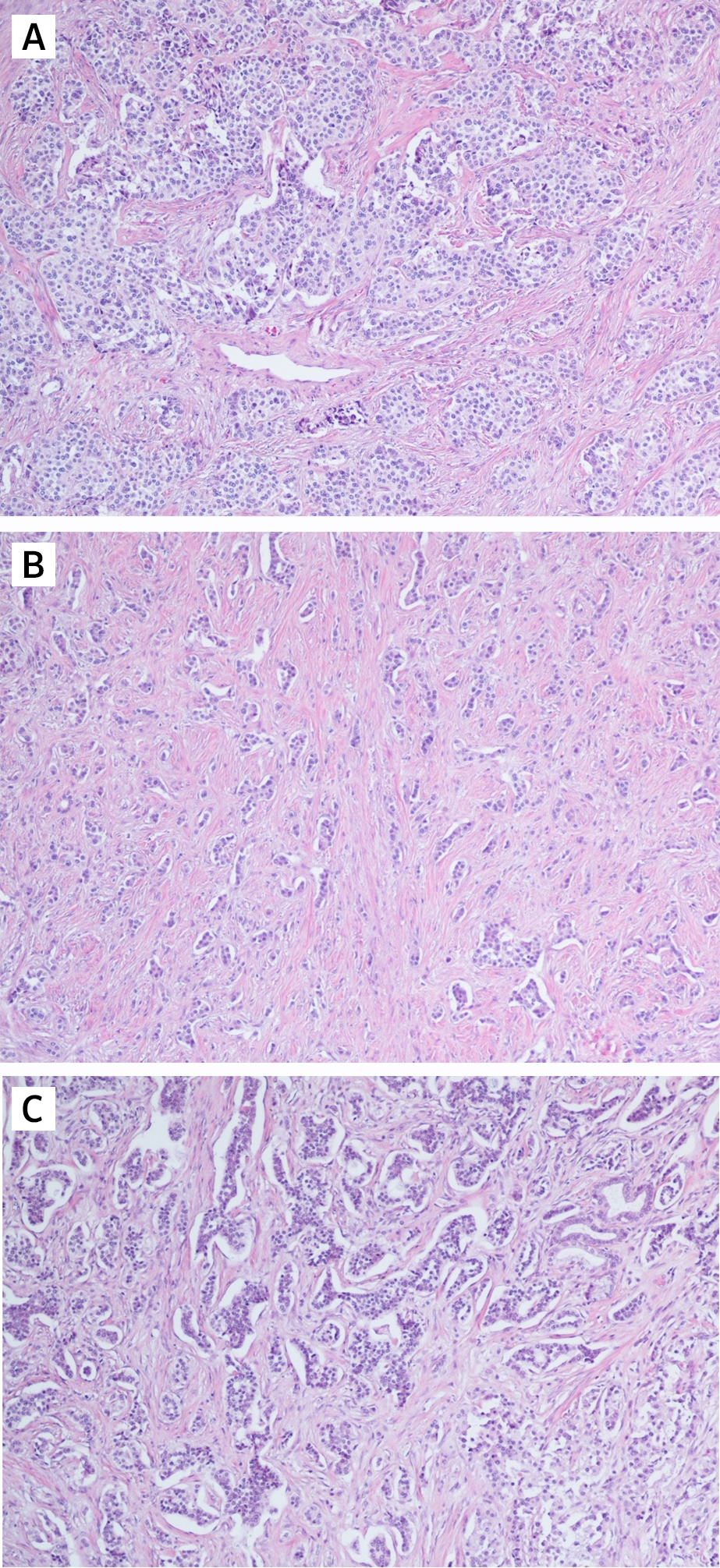 Особенности диагностики нейроэндокринных опухолей