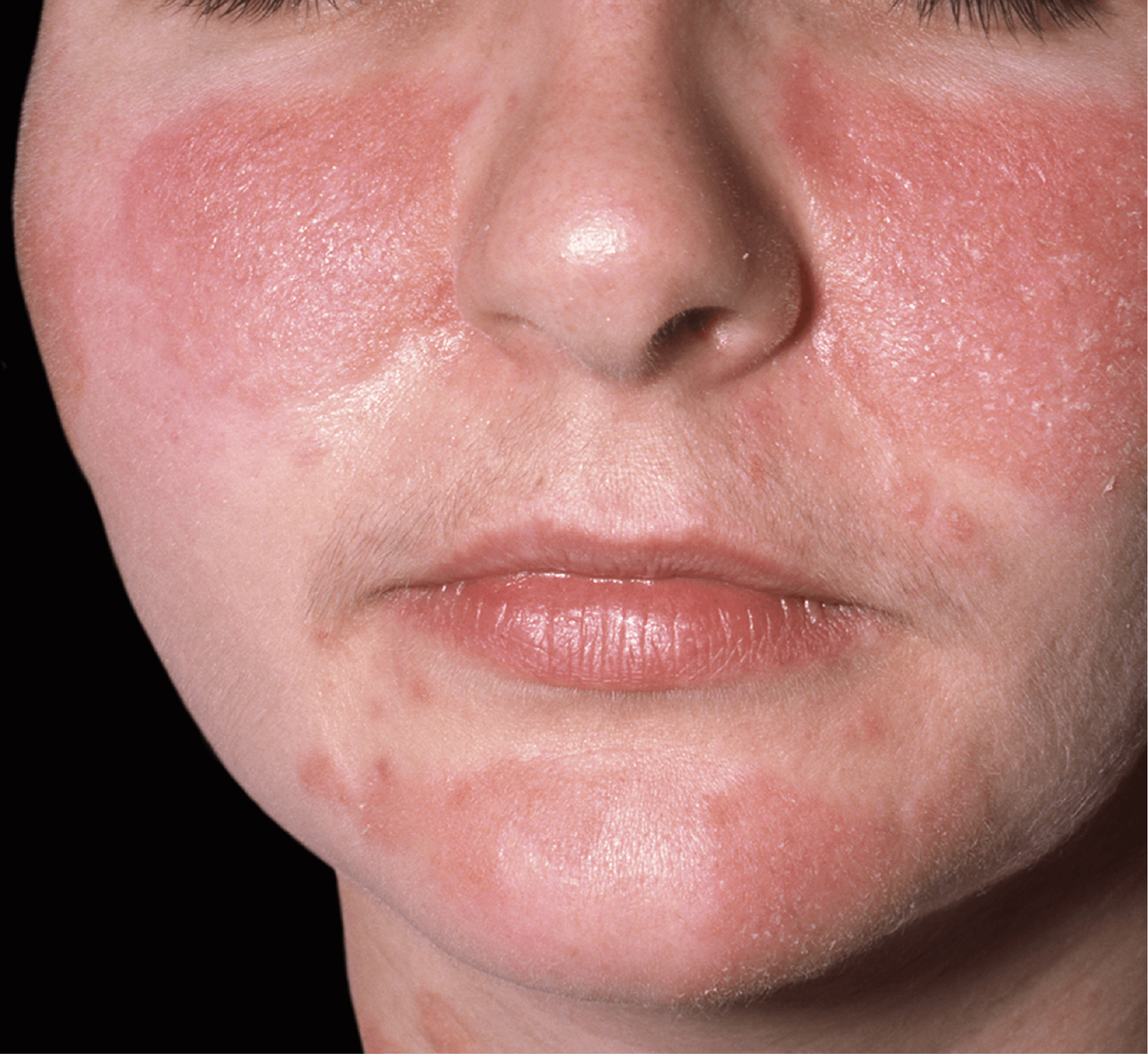 Рациональный уход за кожей у пациентов с периоральным дерматитом