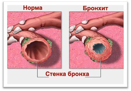 Реабилитация больных хронической обструктивной болезнью легких с применением интервальной нормобарической гипокситерапии и энтеральной оксигенотерапии